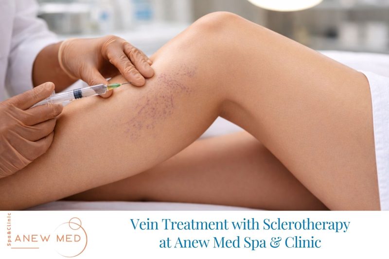 Vein Treatment with Sclerotherapy at Anew Med Spa & Clinic